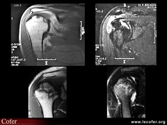 Ostéonécrose aseptique d’épaule : IRM