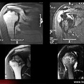 Ostéonécrose aseptique d’épaule : IRM