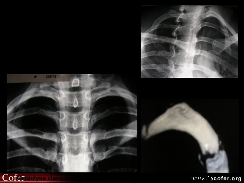 Syndrome de Ghoram : foyer d'ostéolyse intra-médullaire ou sous-cortical, associé à un amincissement sous-cortical conduisant à une destruction de tout ou partie de la pièce osseuse sans aucune réaction osseuse ou périostée péri-lésionnelle, unifocal ou multifocal envahissant les os voisins. 000000000142s.jpg