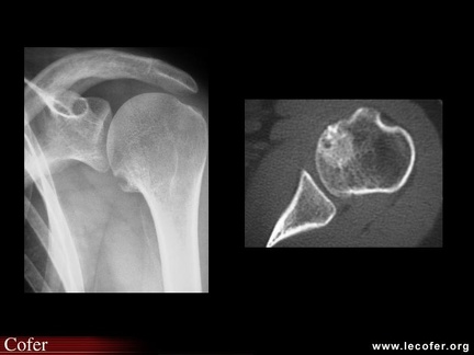Ostéome ostéoïde : humérus