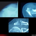 Arthrite acromio-claviculaire