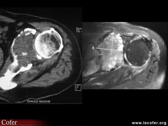 Métastases osseuses, comparaison entre scanner et IRM (métastase omoplate)
