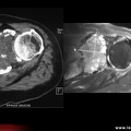 Métastases osseuses, comparaison entre scanner et IRM (métastase omoplate)