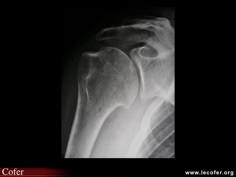 Algodystrophie de l’épaule droite. 000000000705s.jpg