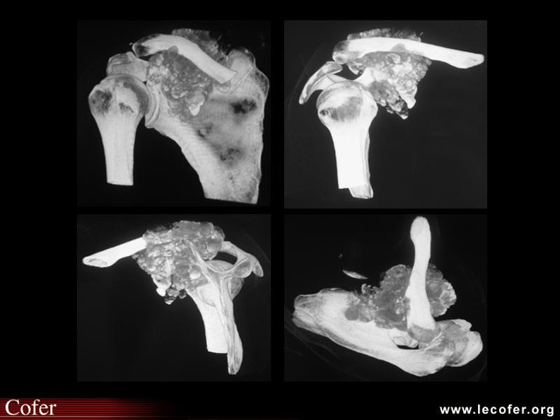 Insuffisance rénale chronique, calcification pseudo- tumorale de l’épaule