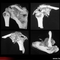 Insuffisance rénale chronique, calcification pseudo- tumorale de l’épaule