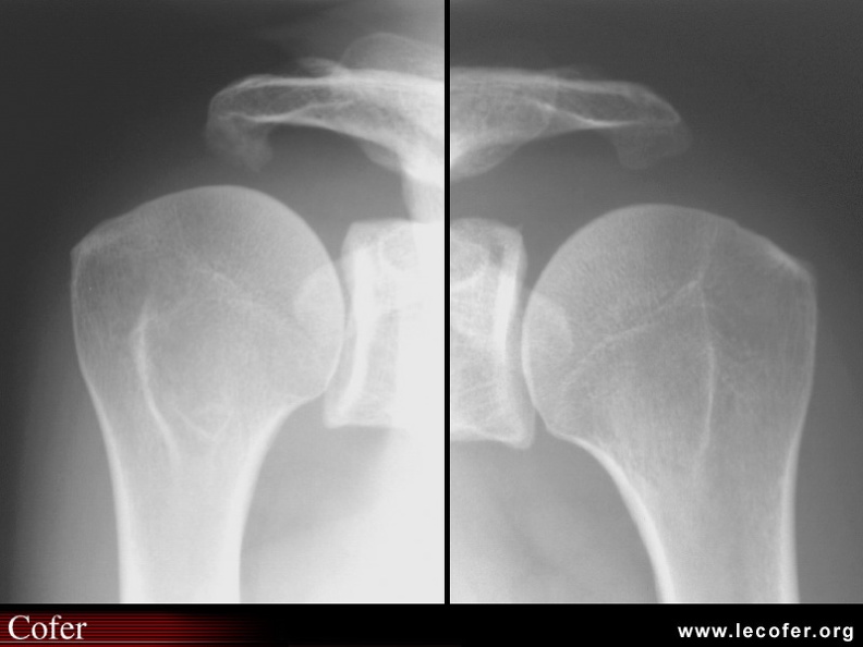 Atteinte de l'épaule dans les spondylarthrites. Aspect « d'acromion barbu » : enthésopathie ossifiante du ligament coraco-acromial dans une spondylarthrite. 020202102.jpg