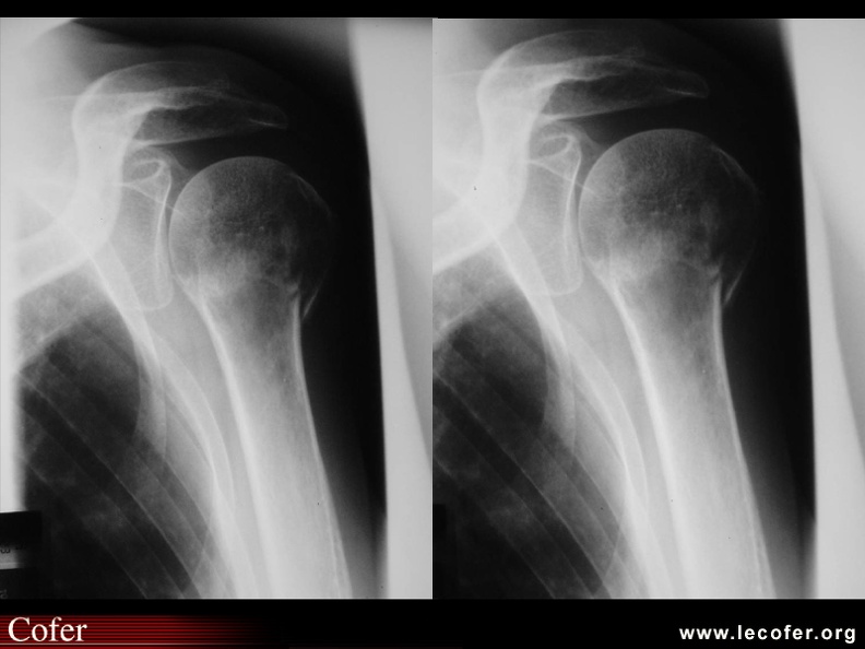 Fracture du col chirurgical de l'humérus. 050102014.jpg
