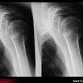 Fracture du col chirurgical de l'humérus, fracture de l'humérus)