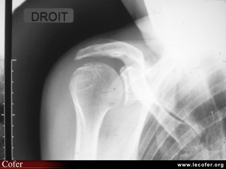Fracture de l'humérus droit : fracture du trochiter. 050102049.jpg