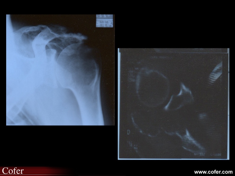Myélome multiple : Radiographie et tomodensitométrie d’un myélome solitaire de l’omoplate
