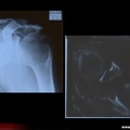Myélome multiple : Radiographie et tomodensitométrie d’un myélome solitaire de l’omoplate