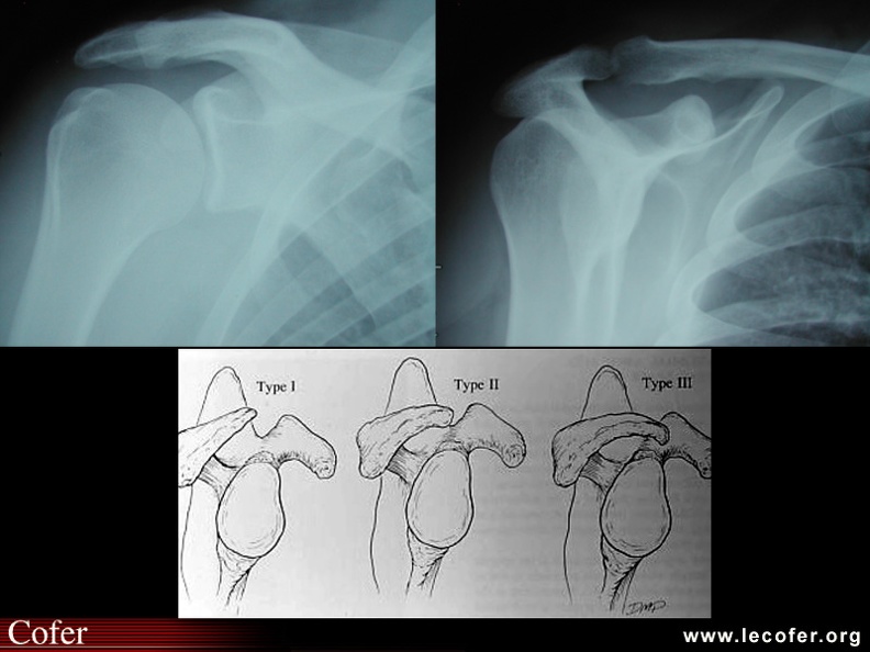 Épaule : radiographie normale