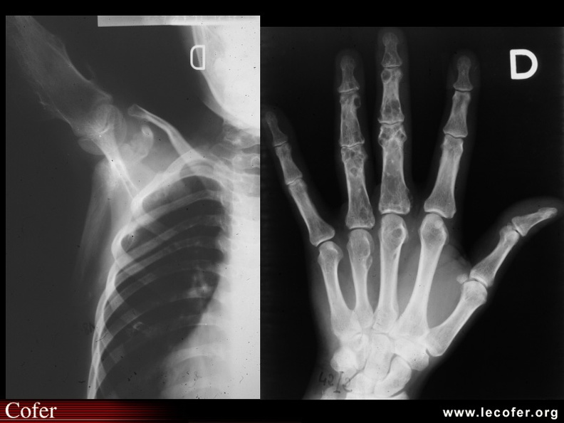 Enchondromes multiples : humérus, phalange. 090400017.jpg