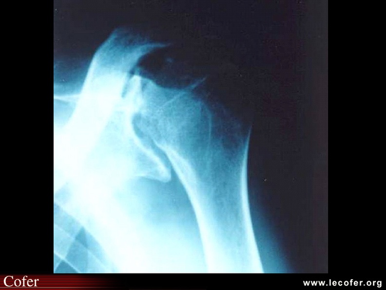 Atteinte destructrice sévère de l'épaule dans le cadre d'une MSA. L'aspect radiologique est aspécifique. SA008.jpg