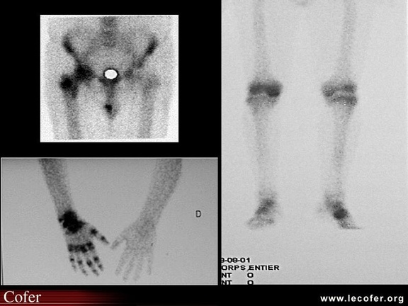 Algoneurodystrophie, algodystrophie : scintigraphie osseuse