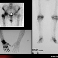 Algoneurodystrophie, algodystrophie : scintigraphie osseuse