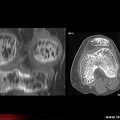 Algoneurodystrophie, algodystrophie du genou : TDM