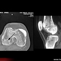 Ostéonécrose du condyle fémoral : tomodensitométrie