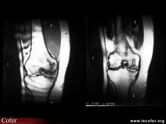 Ostéonécrose du condyle fémoral : IRM T1 et T2
