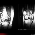 Ostéonécrose du condyle fémoral : IRM T1 et T2