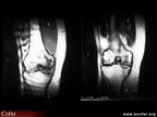 Ostéonécrose du condyle fémoral : IRM T1 et T2