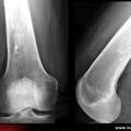 Infarctus osseux : radiographies