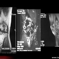 Infarctus osseux multiples du fémur et du tibia : aspects en IRM