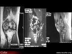 Infarctus osseux multiples du fémur et du tibia : aspects en IRM