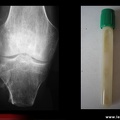 Arthrite septique après amputation de jambe
