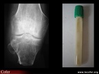 Arthrite septique après amputation de jambe