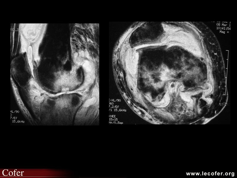 Arthrite septique du genou (T2 avec saturation de la graisse)