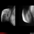 Algodystrophie de la rotule (avant et après guérison)