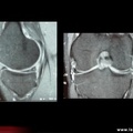 Lésion méniscale postéro-interne / fissure méniscale