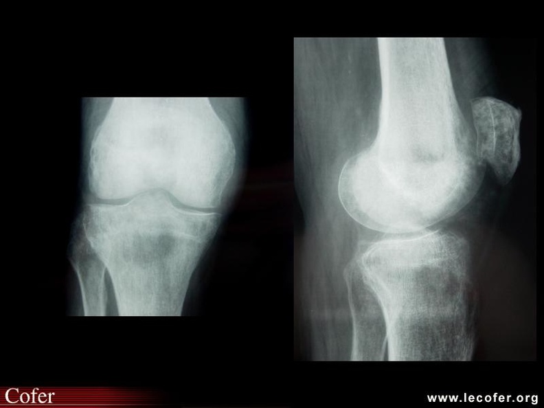 Algodystrophie. 000000000523s.jpg