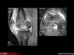 Arthrite septique du genou (IRM)