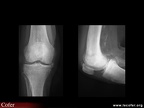 Chondrocalcinose articulaire du genou