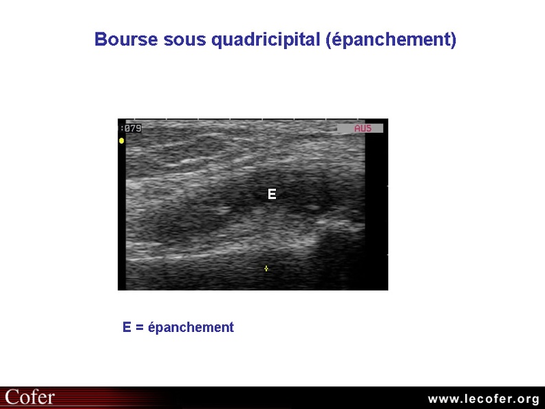 Épanchement du genou (arthrose), échographie