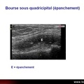 Épanchement du genou (arthrose), échographie