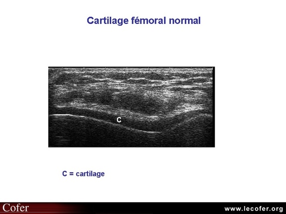 Cartilage normal, échographie