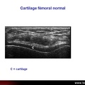 Cartilage normal, échographie