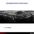 Cartilage arthrosique, échographie
