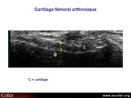 Cartilage arthrosique, échographie