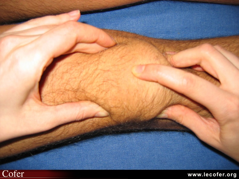 Polyarthrite rhumatoïde – PR début ; détection d'une synovite (épanchement) du genou ; choc rotulien ; avec la pression de l'index, on sent la rotule traverser le liquide synovial et taper sur le fémur. 0201010007.jpg