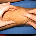 Polyarthrite rhumatoïde, PR débutante, PR ; détection d’une synovite (épanchement) du genou ; choc rotulien
