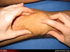 Polyarthrite rhumatoïde, PR débutante, PR ; détection d’une synovite (épanchement) du genou ; choc rotulien