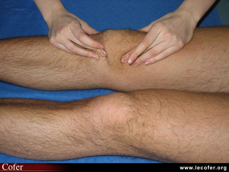 Polyarthrite rhumatoïde, PR débutante, PR ; détection d’une synovite (épanchement) du genou ; fluctuation