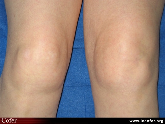 Polyarthrite rhumatoïde, PR débutante, PR ; reconnaître l’atteinte inflammatoire précoce du genou