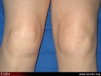 Polyarthrite rhumatoïde, PR débutante, PR ; reconnaître l’atteinte inflammatoire précoce du genou