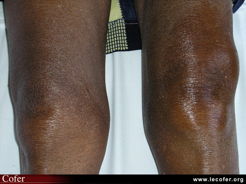 Arthrite du genou gauche : vue du patient de face